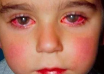 Lodra që dëmton fëmijët, largojeni menjëherë para se të jetë vonë