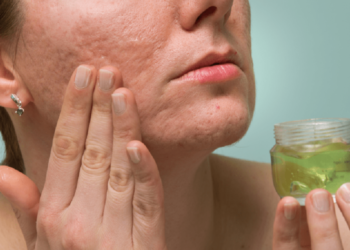 Tre trajtime të shpejta për të larguar shenjat e akneve