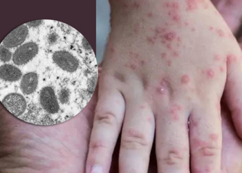 257 raste të konfirmuara me linë e majmunëve, OBSH: Pritet rritje