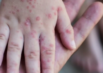 Gjermania drejt marrjes së masave për lijën e majmunëve