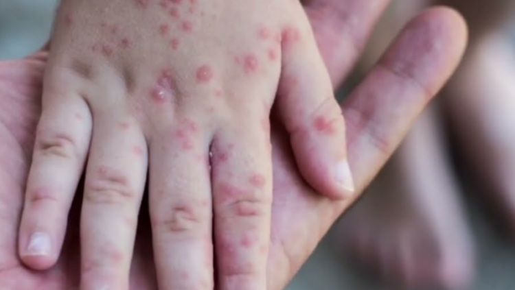 Gjermania drejt marrjes së masave për lijën e majmunëve