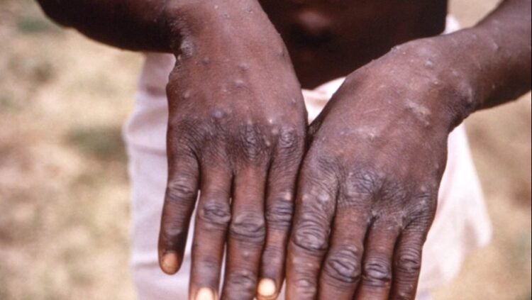 Lija e majmunëve, Shtëpia e Bardhë prezanton planin për vaksinim