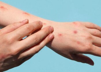 Lija e majmunit, Europa do të zgjerojë vaksinimin kundër sëmundjes