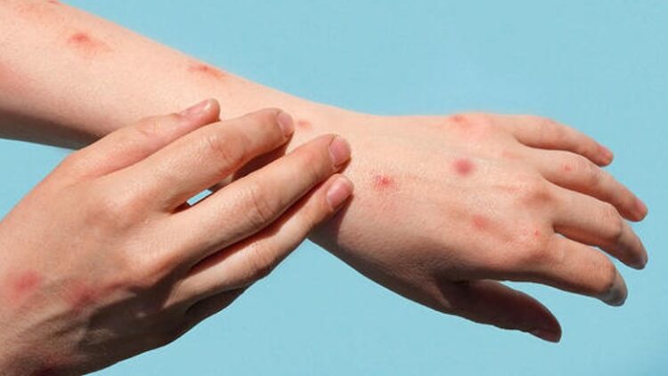 Lija e majmunit, Europa do të zgjerojë vaksinimin kundër sëmundjes